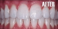 dental teeth whitening after picture shows whiter teeth in Calgary