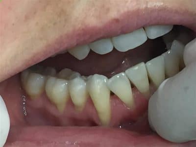 adult teeth straightening invisilign procedure