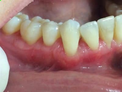 Teeth straightening invisalign treatment in Calgary results