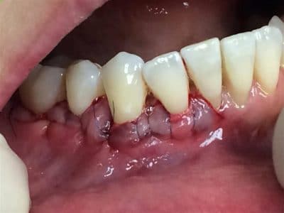 adult teeth straightening invisilign in Calgary