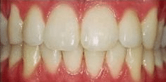 dental teeth whitening before picture shows how to get whiter teeth in Calgary